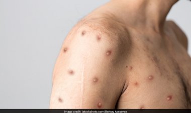 मंकीपॉक्स का खतरा, रायपुर के 19 बच्चे क्वॉरेंटाइन