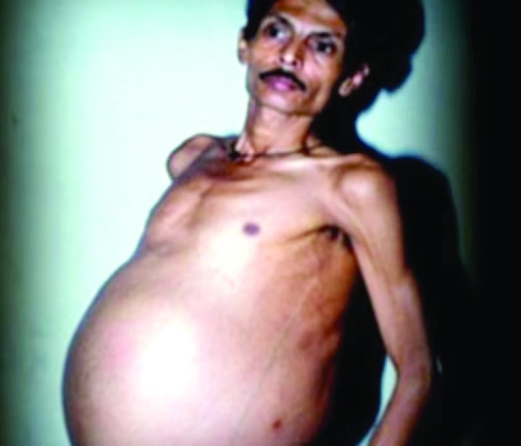 गया था ट्यूमर का इलाज कराने, 36 वर्षीय शख्स के पेट से निकला जुड़वा बच्चे