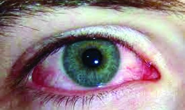 इस जिले में आई फ्लू का कहर, एक की स्कूल  के 17 स्कूली विद्यार्थी प्रभाावित, आंकड़ा 300 के पास