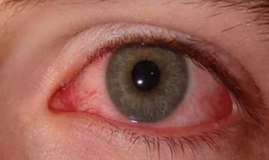 छत्तीसगढ़ में आई फ्लू के अब तक 19,873 मामले