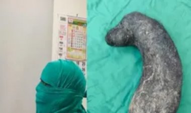 इस कारण महिला के पेट से निकला ढाई किलो बाल