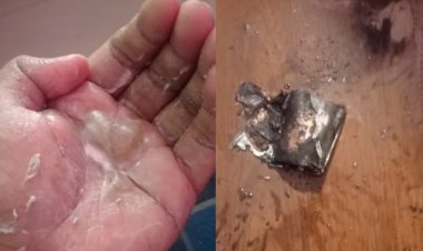 बच्चे के हाथ में मोबाइल की बैटरी हुई ब्लास्ट