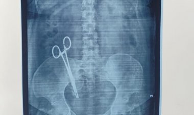 17 साल पहले डॉक्टर ने पेट में छोड़ दिया था कैंची, एक्सरे में खुलासा